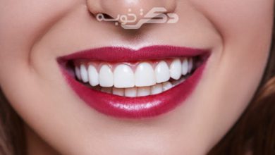 بهترین دکتر لمینت دندان در کرج
