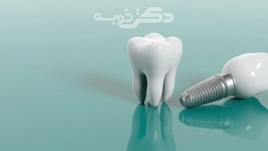 بهترین مرکز ایمپلنت دندان در شریعتی
