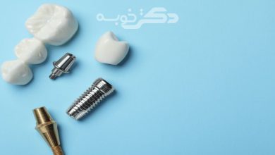 بهترین مرکز ایمپلنت دندان اقساطی در تهران